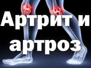 Суставы, надпись: артрит и артроз