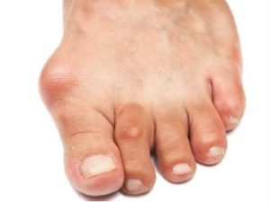 Артроз фалангов пальцев стопы лечение