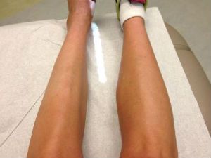 Атрофирование мышц ног симптомы. Как восстановить атрофированные мышцы. Мышечная дистрофия Дюшенна