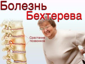 Болезнь Бехтерева