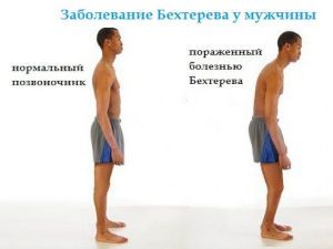 Бехтерева у мужчин