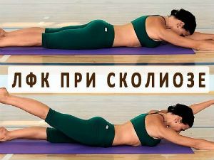 Лечебная гимнастика при сколиозе