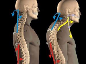 Сколиоз шеи фото
