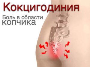 Кокцигодиния