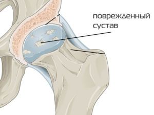 Поврежденный тазобедренный сустав