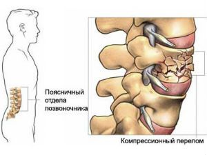 Компрессионный перелом позвоночника картинки