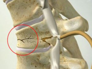 Компрессионный перелом позвоночника у детей фото