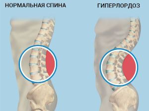 Лордоз шейного отдела фото