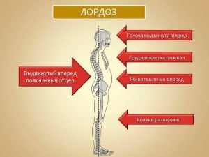 Лордоз фото людей
