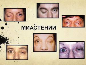 Миастении