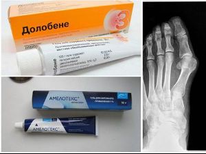 Мази Долобене и Амелотекс, снимок стопы