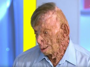 Человек с нейрофиброматозом