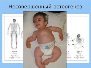 Младенец с кривыми костями