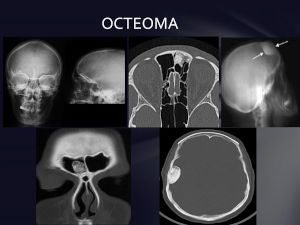Остеома лобной кости фото