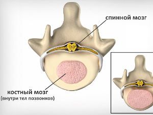 Отечность костного мозга