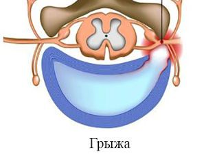 Парамедианная грыжа