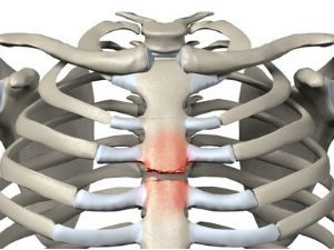 Перелом грудины презентация