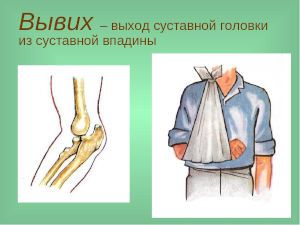 Вывих