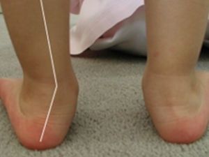 Кривая ножка у ребенка