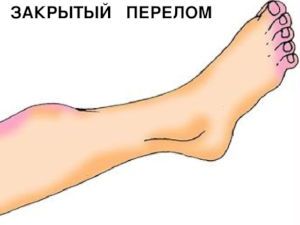 Нога с посиневшими участками